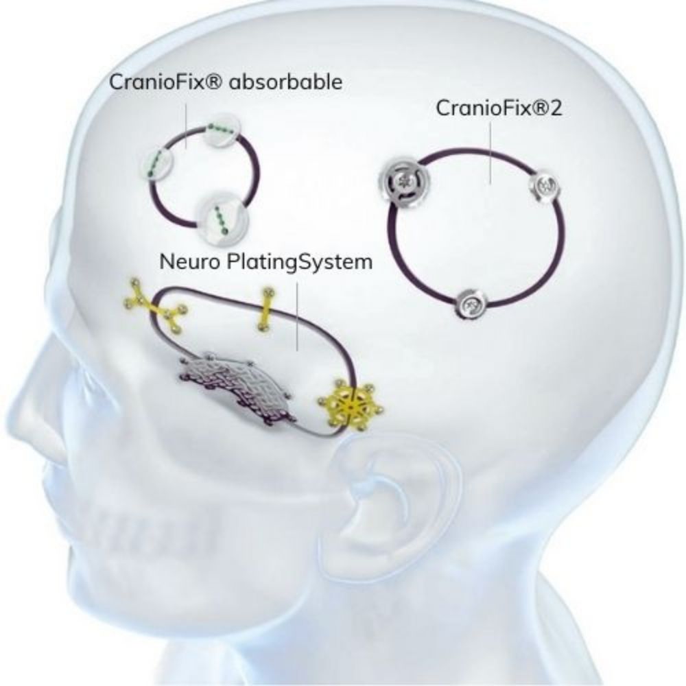 Fijación Craneal